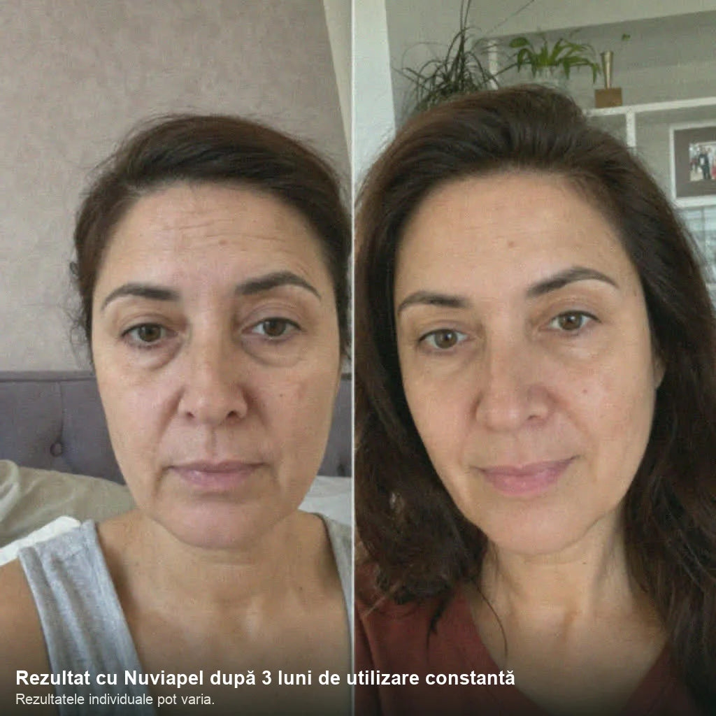 Înainte și după cu Nuviapel după 3 luni — rezultat